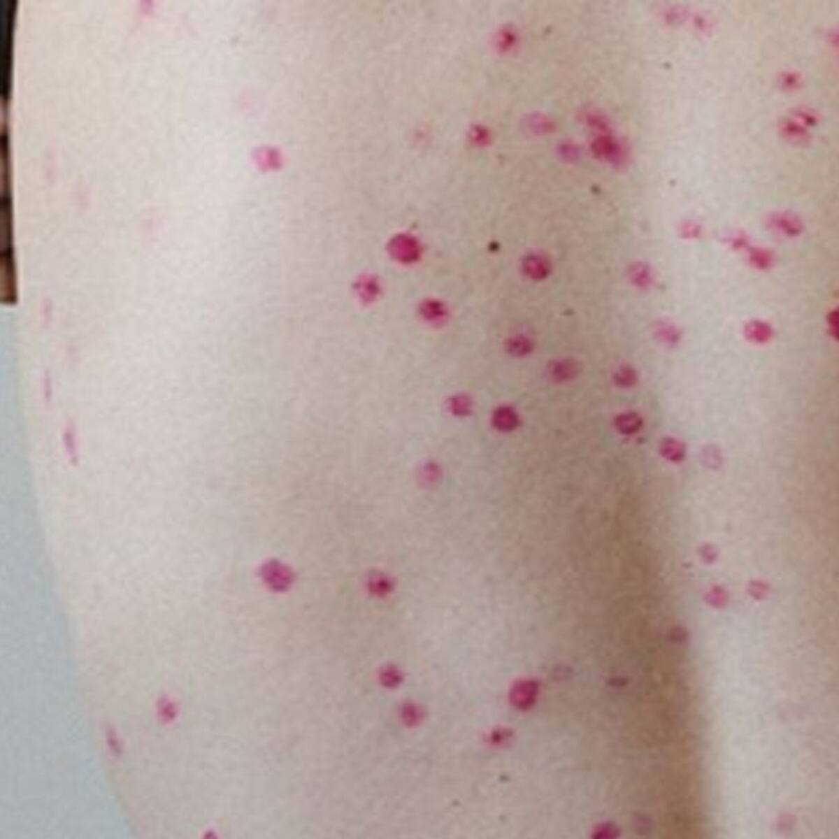 Confirmado primer caso de viruela del mono en Bucaramanga