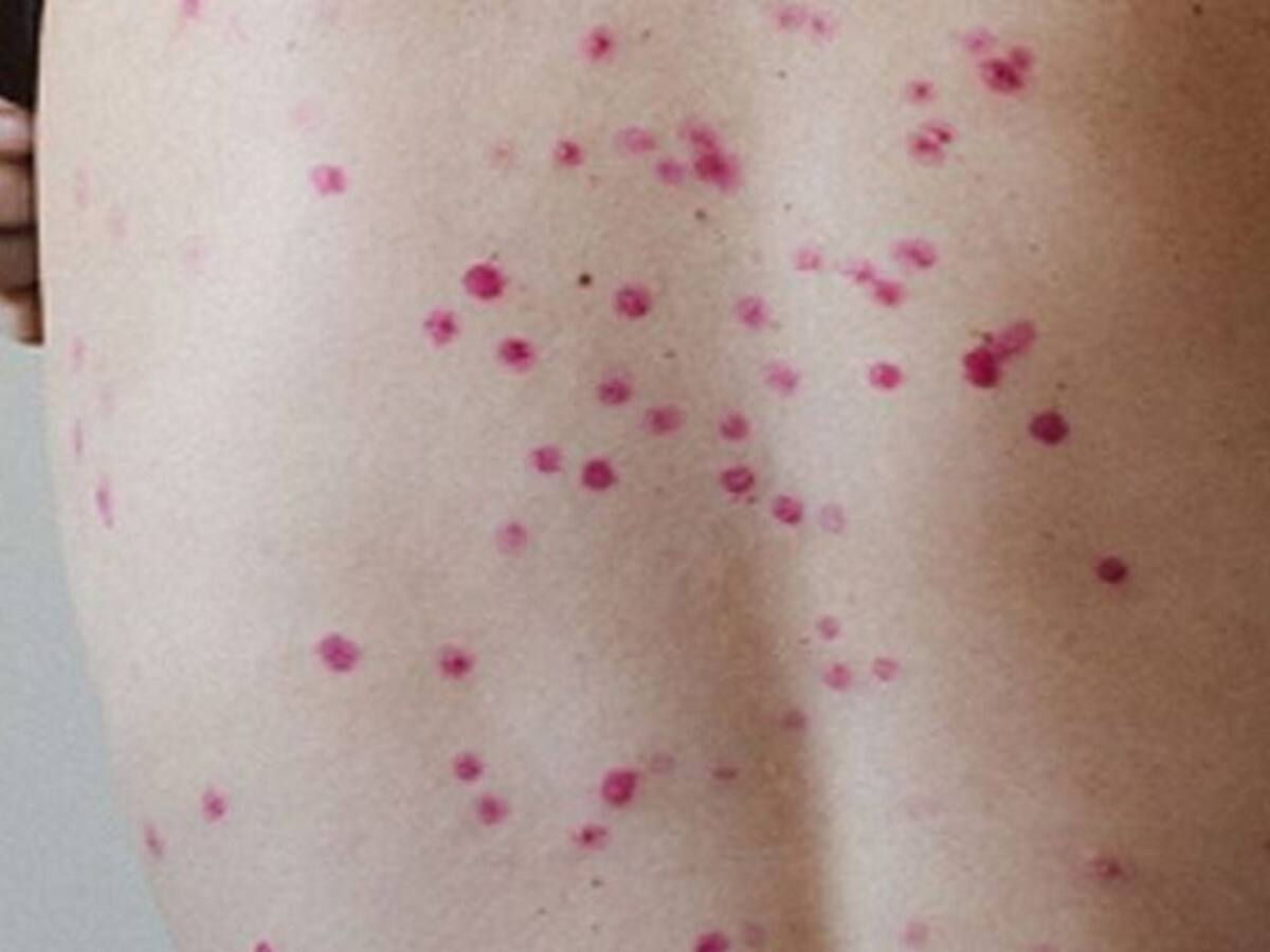 Confirmado primer caso de viruela del mono en Bucaramanga