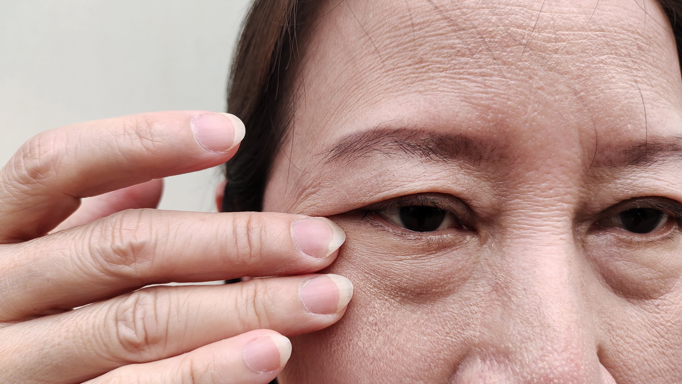 Mujer con párpado caído // Getty Images