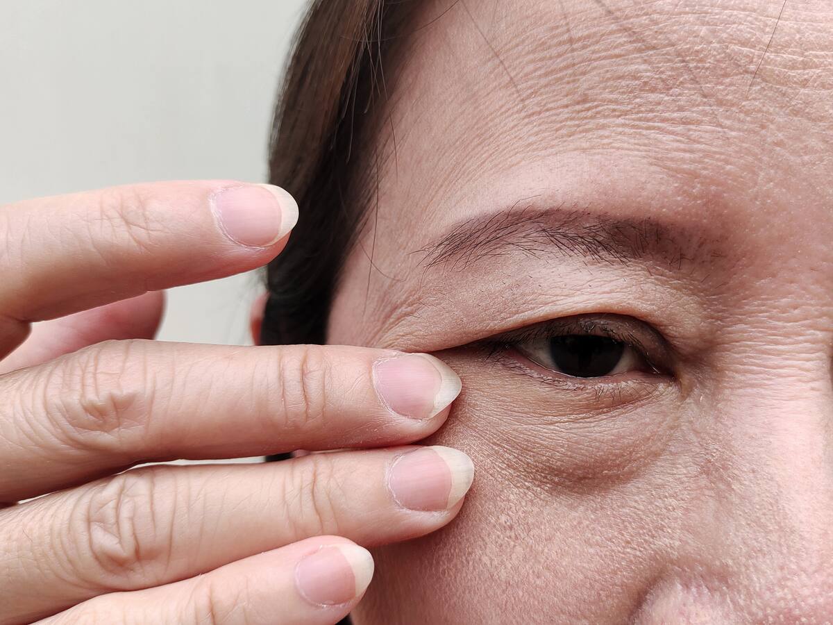 ¿Qué es bueno para levantar los párpados caídos? Estos son algunos métodos