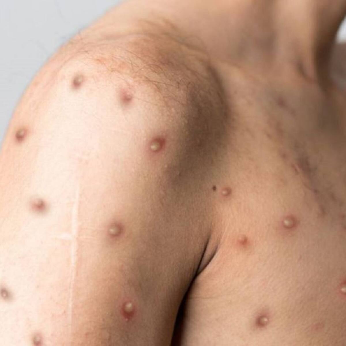 En Medellín se registraron dos nuevos contagios de la viruela símica