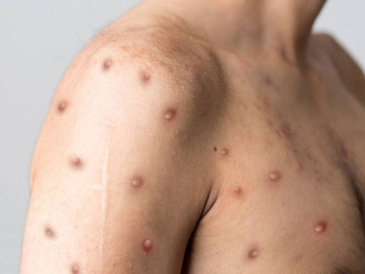 En Medellín se registraron dos nuevos contagios de la viruela símica