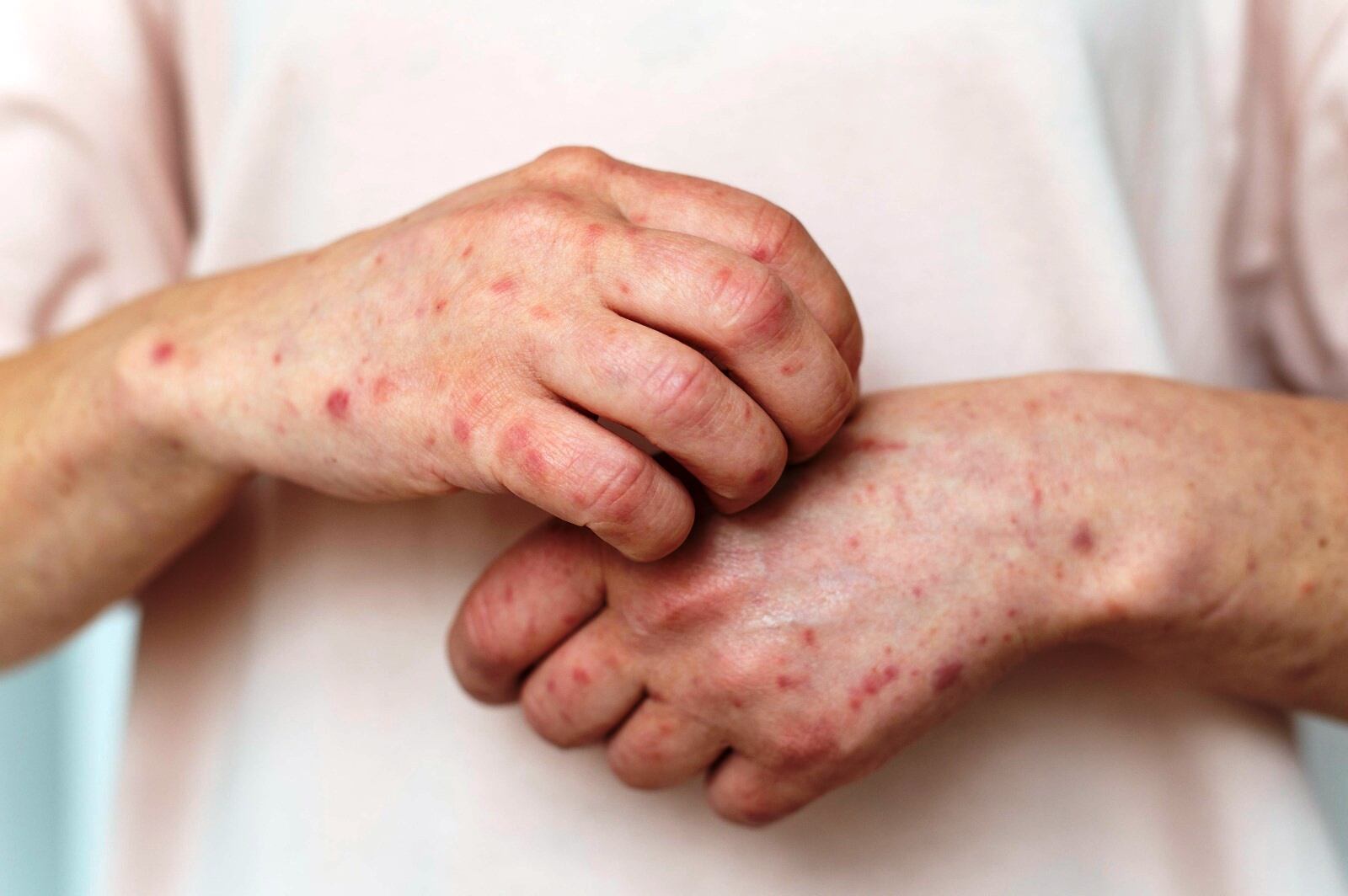 Lo que necesitas saber sobre el lupus desde el Hospital Serena del Mar