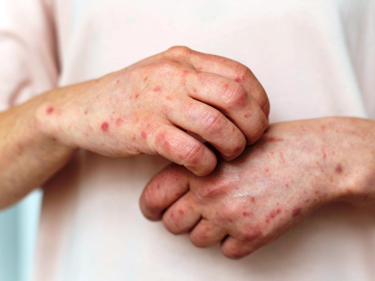 Lo que necesitas saber sobre el lupus desde el Hospital Serena del Mar