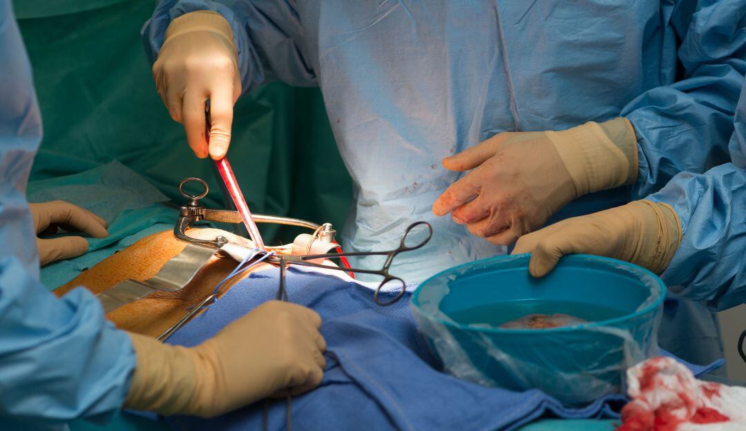 Cirugías comunes para trasplantes de riñón