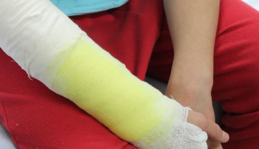 Quemados por pólvora en Caldas