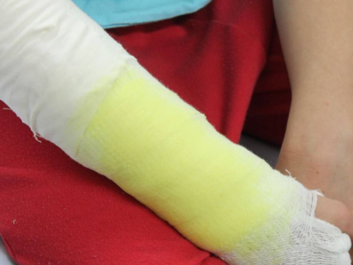 En Marmato una persona resultó quemada por pólvora