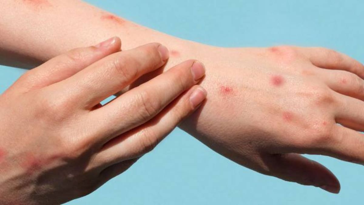 Posible brote de varicela en institución educativa de Pereira