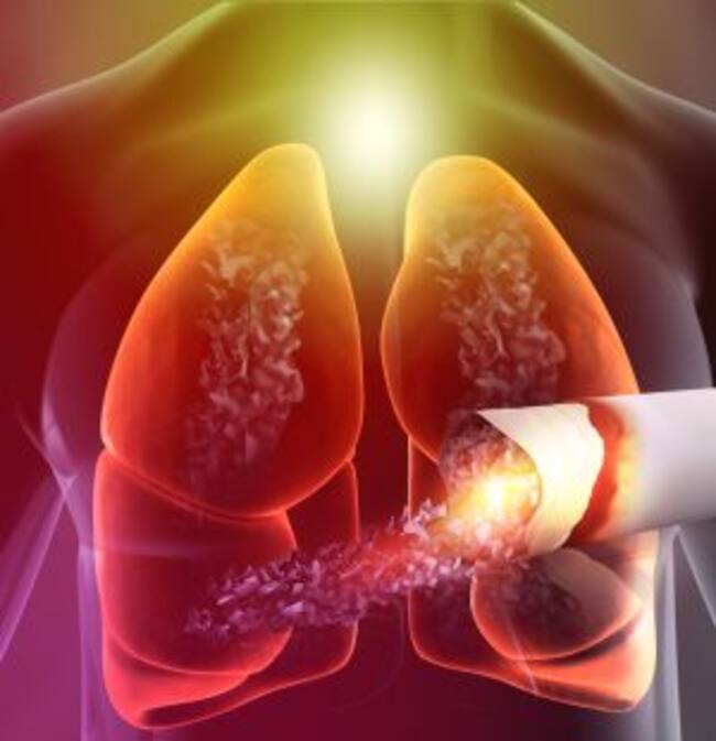 El costo mundial del cáncer se estima en cerca de 1,16 billones de dólares (WCD, 2021)