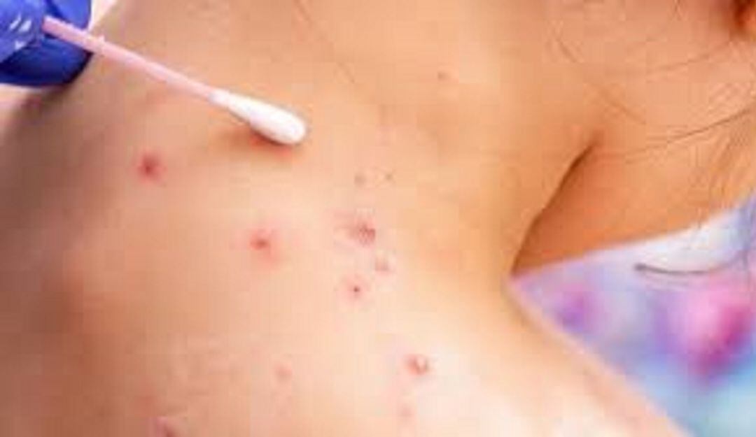 A seis se elevan los casos confirmados de la viruela símica en Ibagué