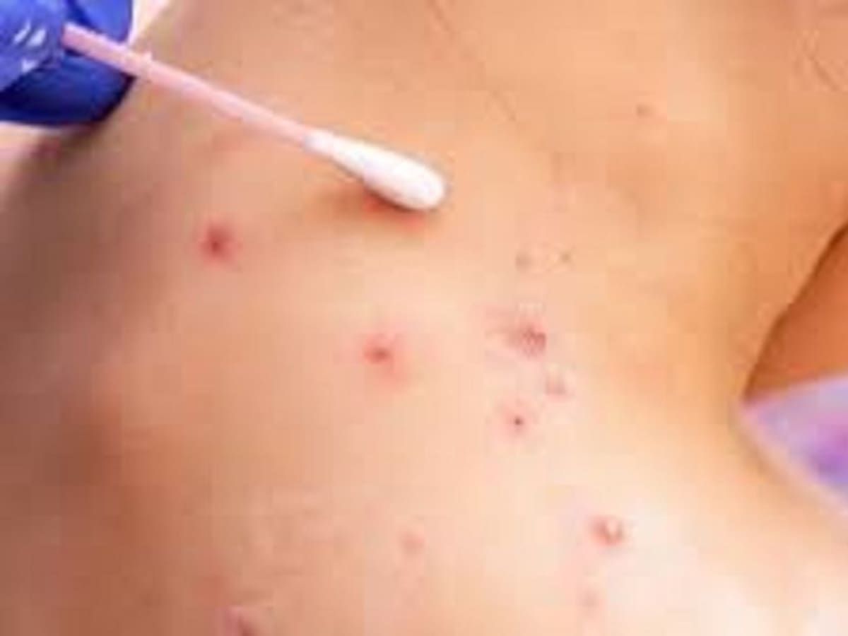 Seis casos positivos confirmados de viruela del mono en Ibagué