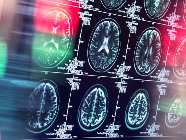 Claves para fortalecer la memoria y prevenir el Alzhéimer, según experto  // Getty Images
