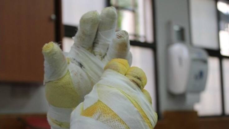 En La Tebaida se reporta el primer quemado con pólvora de este año