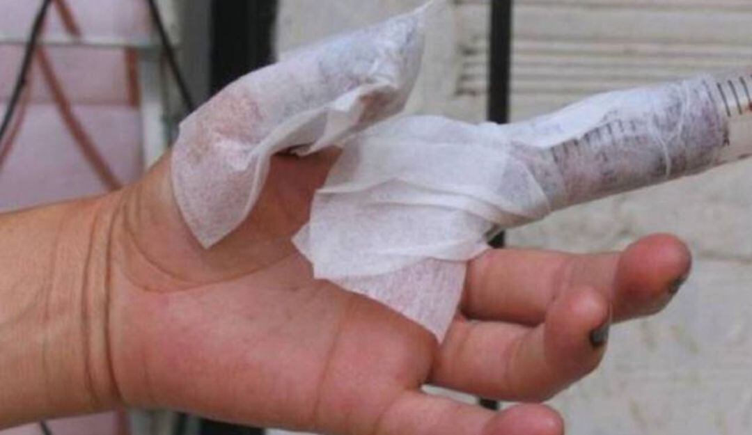 Persona quemada con pólvora 