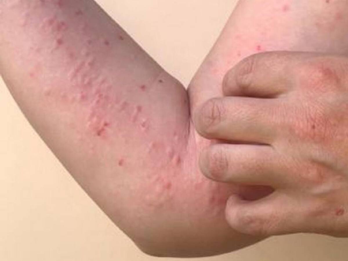 Huila procesará muestras de viruela del Mono