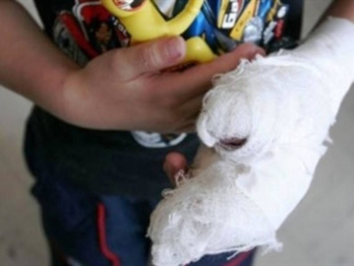 Entre 4 y 6 meses podrían quedar en custodia del ICBF los niños quemados con pólvora