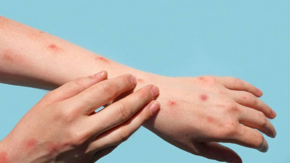 Atlántico empezará a hacer pruebas para identificar viruela del mono
