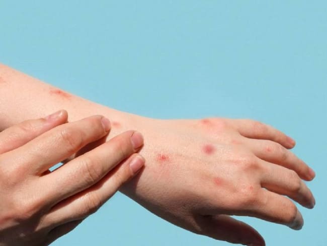 Imagen sobre afectaciones de la viruela del mono