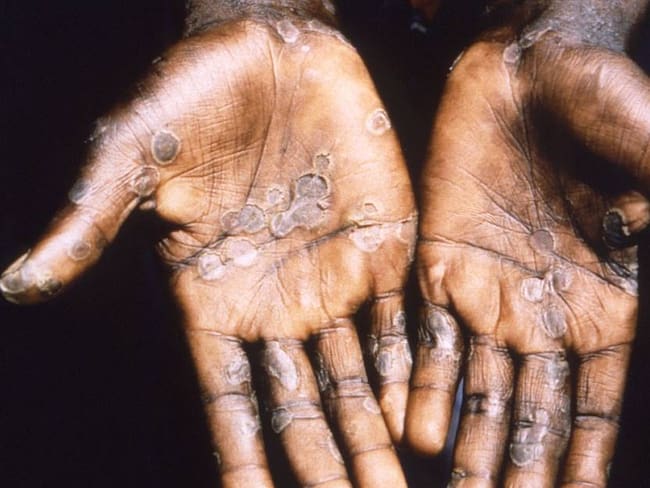 Lesiones en la piel tras contagio con viruela del mono.              Foto: Getty 