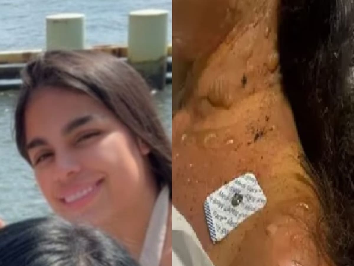 Denuncian negligencia en atención a colombiana que sufrió quemaduras en un bar en Estados Unidos