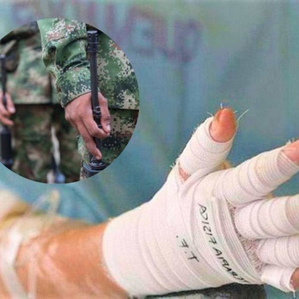 Hospital Militar reporta estado crítico de subteniente quemado en Putumayo