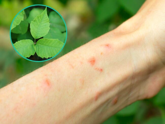 Reacción a planta venenosa/Hiedra Venenosa (Getty Images).