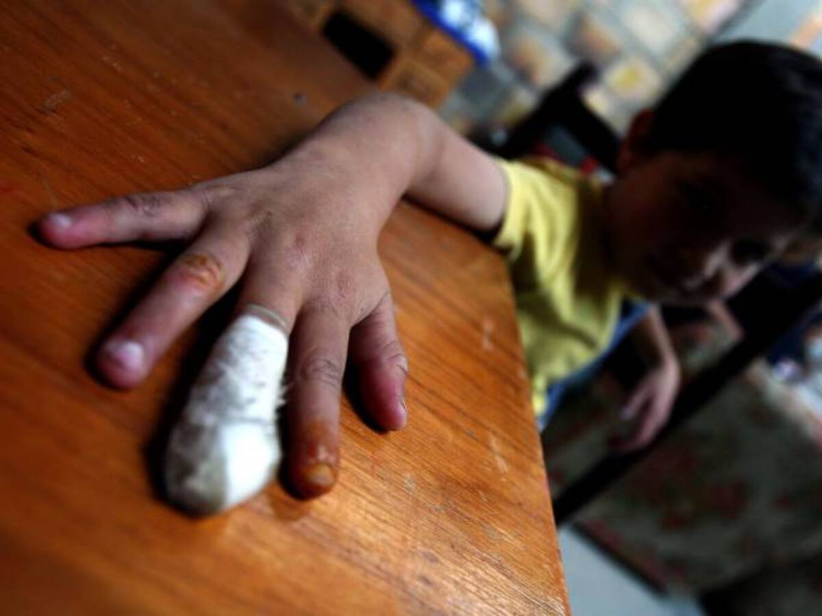 Reportan dos nuevos casos de menores afectados por pólvora en Bolívar