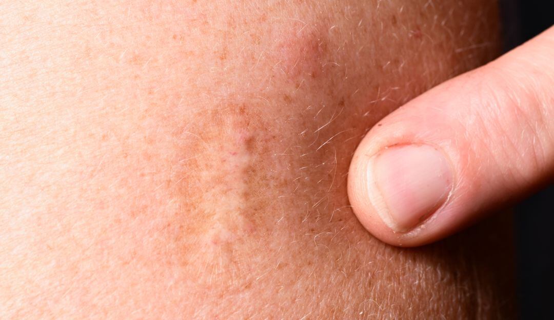 La vacuna de la viruela común se está usando para la viruela del mono. 