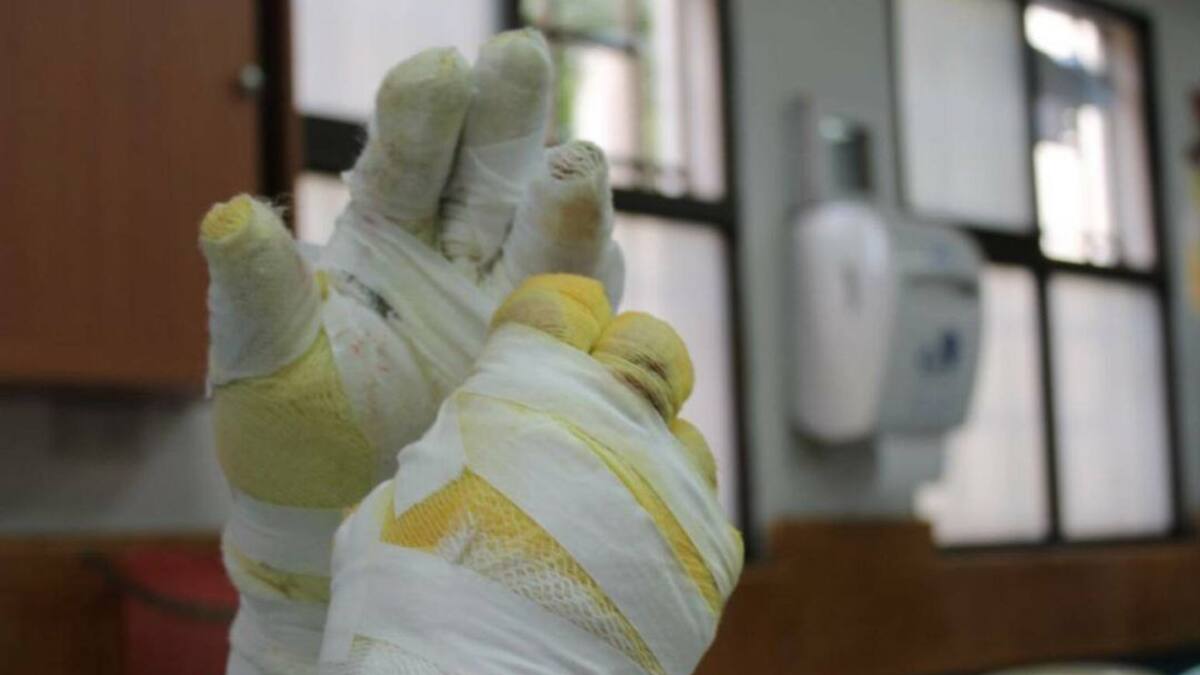 Segundo quemado con pólvora en Risaralda estaba bajo efectos del alcohol