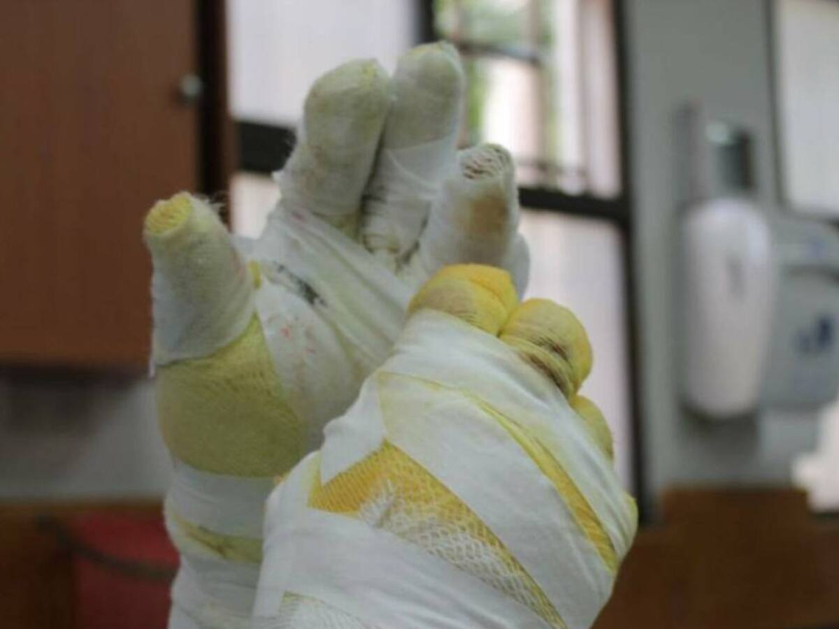 Segundo quemado con pólvora en Risaralda estaba bajo efectos del alcohol