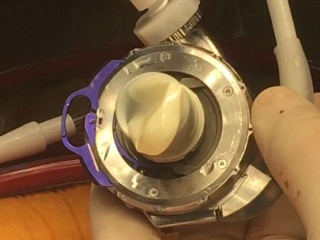 Ya son cinco años del primer implante de corazón artificial en Suramérica