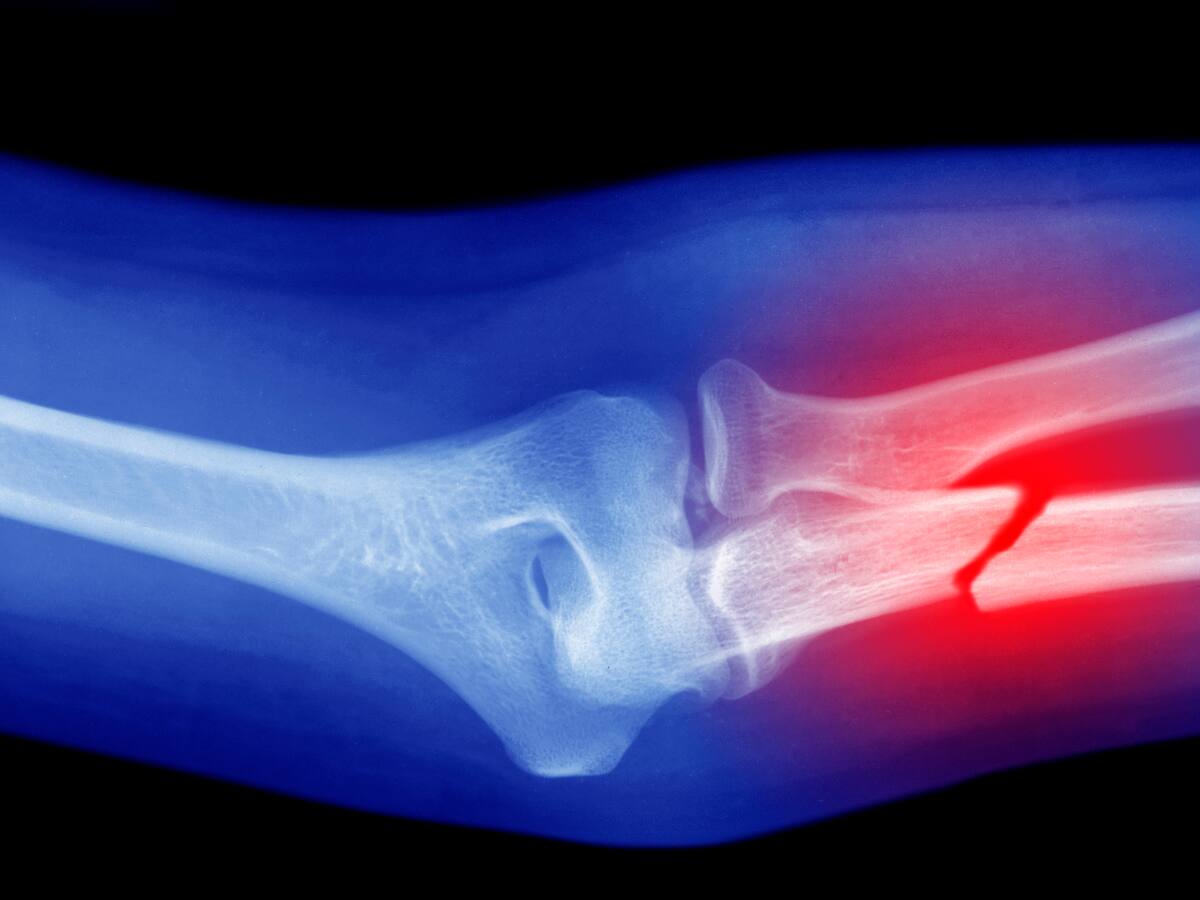 La contaminación del aire está haciendo que los huesos humanos sean más frágiles