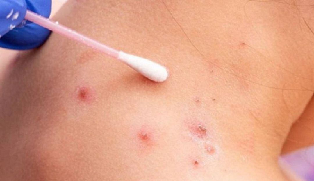 En Quindío solo se han confirmados dos casos de la viruela símica