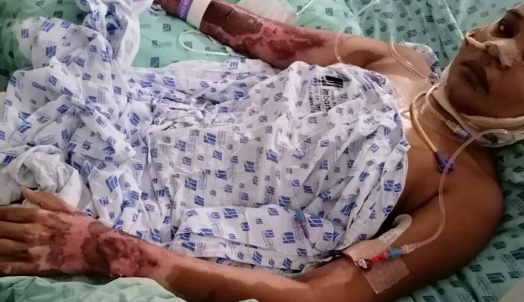 Mujer quemada por su pareja sentimental en el Putumayo clama justicia