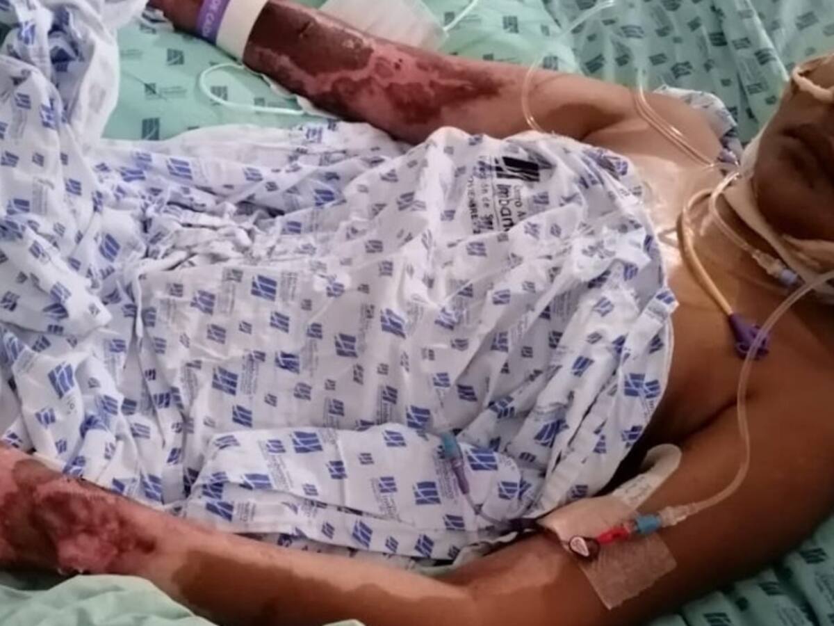 Mujer quemada por su pareja sentimental en el Putumayo clama justicia