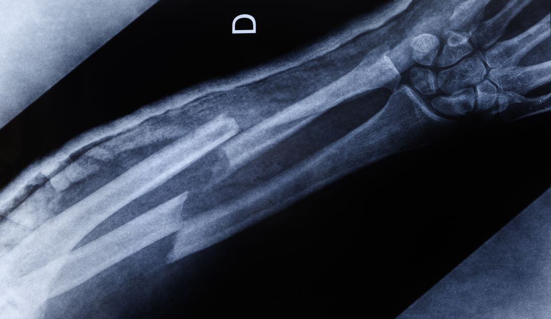 Este método mezcla la ciencia y el diseño para ayudar a pacientes con fracturas