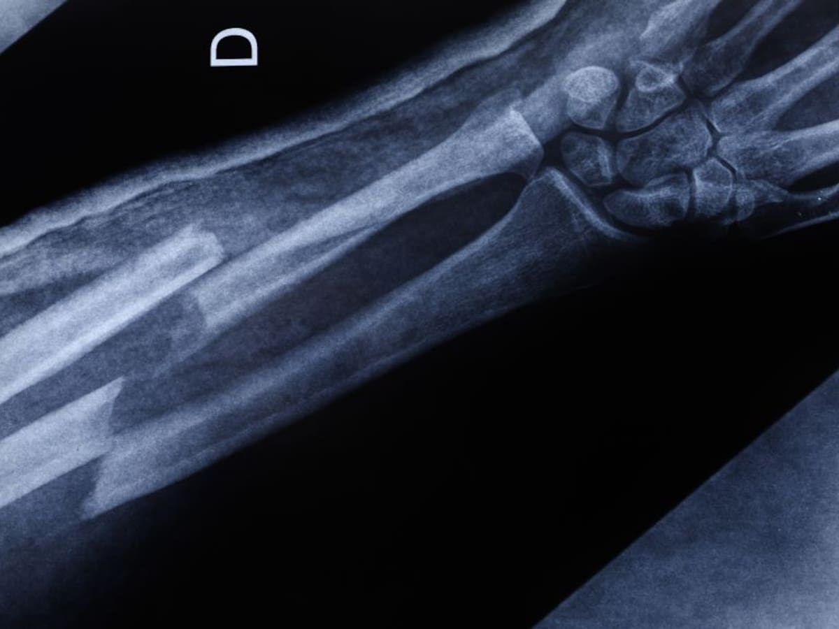 Llega a Bogotá sistema de impresión 3D para la reparación de huesos