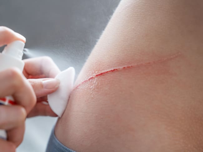 ¿Cómo limpiar herida superficiales? - Getty Images