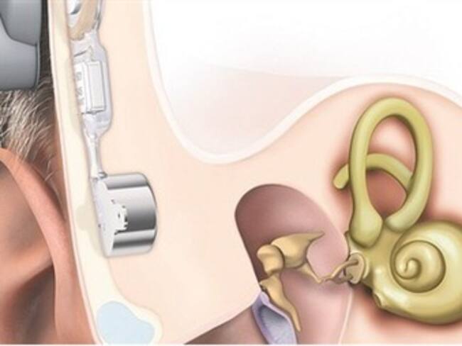 Bonebridge, la alternativa para los que nunca han podido escuchar
