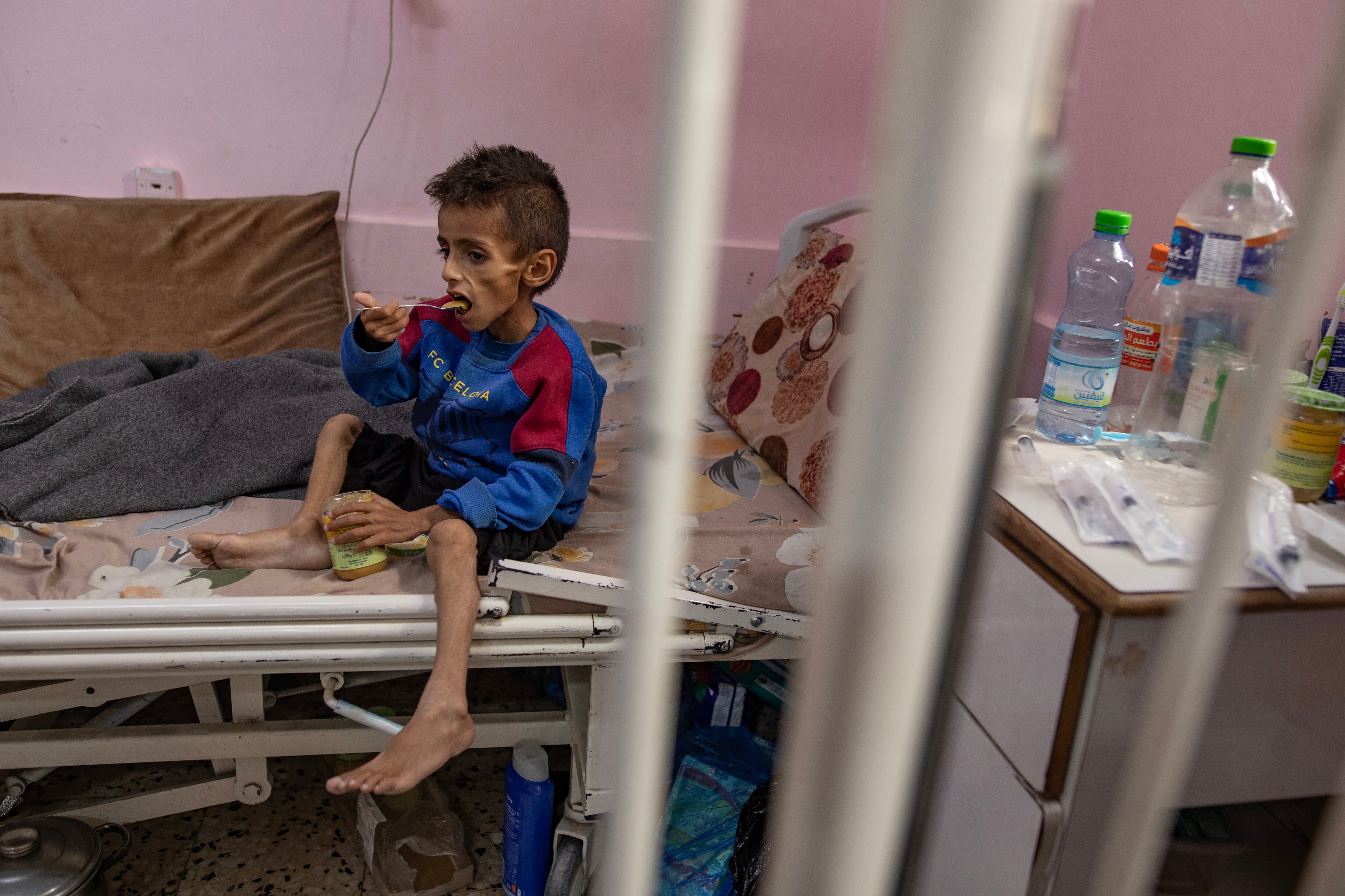 FOTODELDÍA Khan Younis (Gaza), 31/05/2025.- Osama al-Raqab, de cinco años, sufre desnutrición severa y recibe tratamiento en el Hospital Nasser de Khan Youni, en el sur de la Franja de Gaza, este sábado. Su madre, Mona al-Raqab, afirma que el peso de Osama ha bajado a tan solo nueve kilogramos debido al deterioro de su salud causado por la desnutrición persistente. La ONU ha declarado que las familias sufren hambre y se les niegan los medios básicos para sobrevivir, y que solo una pequeña cantidad de ayuda, insuficiente para cubrir las enormes necesidades de la población, ha entrado en la Franja de Gaza tras más de 80 días de bloqueo total por parte de las autoridades israelíes. La ONU declaró que Gaza es el único territorio del mundo donde toda una población corre riesgo de hambruna. EFE/EPA/HAITHAM IMAD ATENCIÓN EDITORES: CONTENIDO SENSIBLE