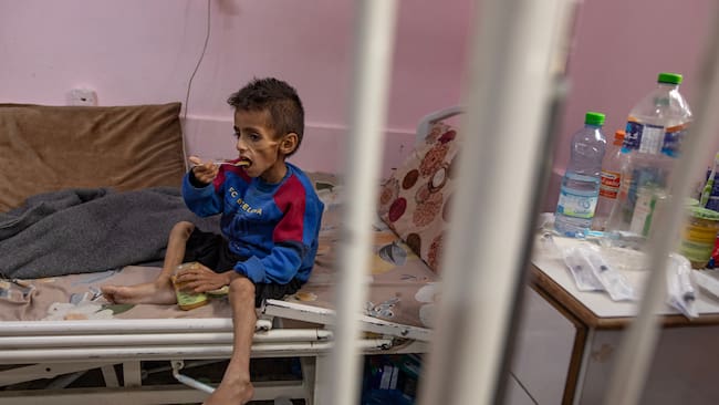 FOTODELDÍA Khan Younis (Gaza), 31/05/2025.- Osama al-Raqab, de cinco años, sufre desnutrición severa y recibe tratamiento en el Hospital Nasser de Khan Youni, en el sur de la Franja de Gaza, este sábado. Su madre, Mona al-Raqab, afirma que el peso de Osama ha bajado a tan solo nueve kilogramos debido al deterioro de su salud causado por la desnutrición persistente. La ONU ha declarado que las familias sufren hambre y se les niegan los medios básicos para sobrevivir, y que solo una pequeña cantidad de ayuda, insuficiente para cubrir las enormes necesidades de la población, ha entrado en la Franja de Gaza tras más de 80 días de bloqueo total por parte de las autoridades israelíes. La ONU declaró que Gaza es el único territorio del mundo donde toda una población corre riesgo de hambruna. EFE/EPA/HAITHAM IMAD ATENCIÓN EDITORES: CONTENIDO SENSIBLE