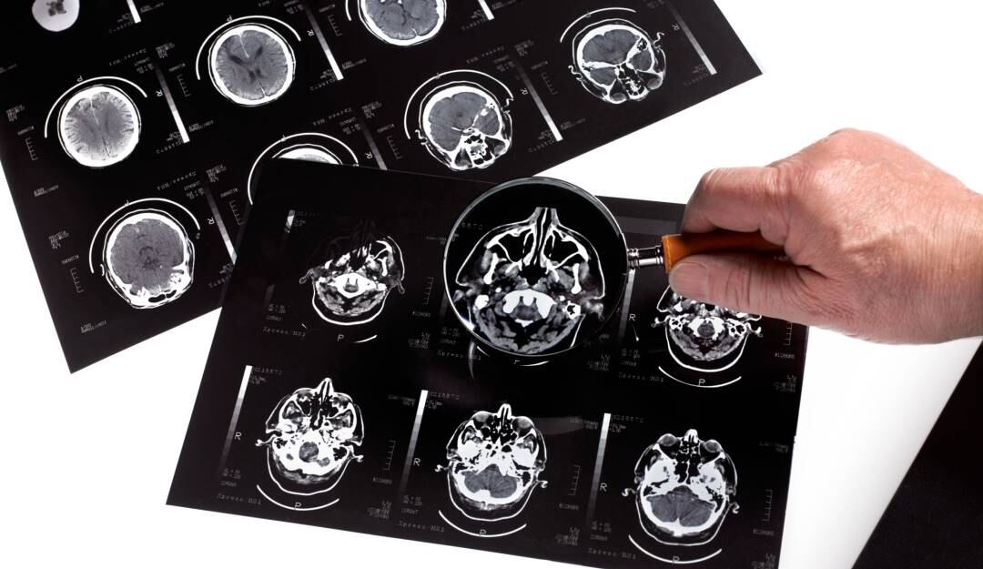 Radiografías cerebrales.                        Foto: Getty 