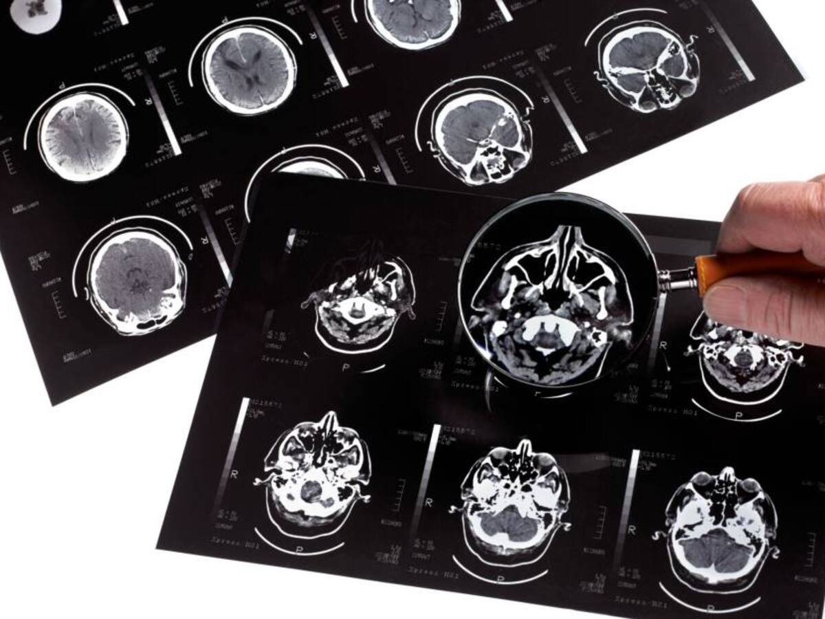 Un fármaco para el corazón podría tratar el Alzheimer