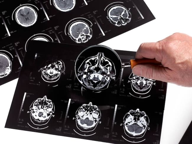 Radiografías cerebrales.                        Foto: Getty 