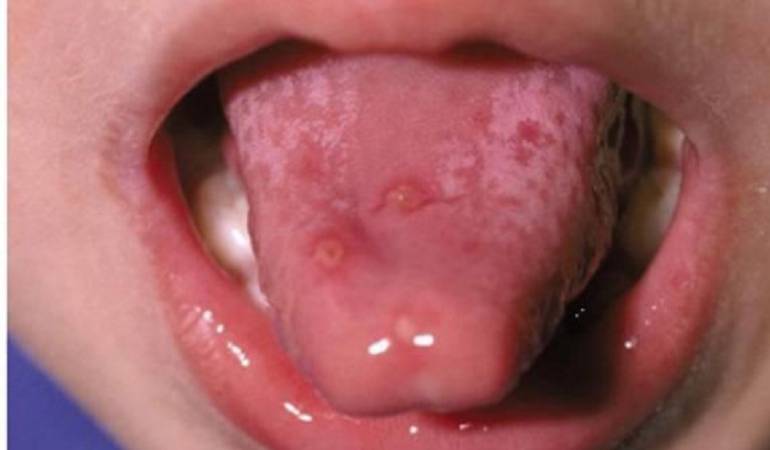 Principales afectados son los menores de edad