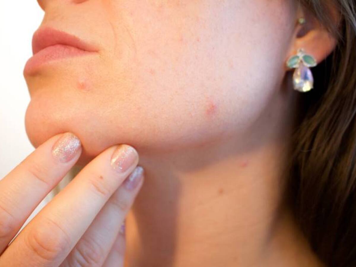 Verdades y mitos sobre el acné