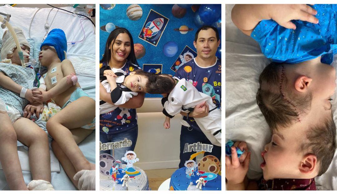 Siameses brasileños fueron separados con ayuda de realidad virtual