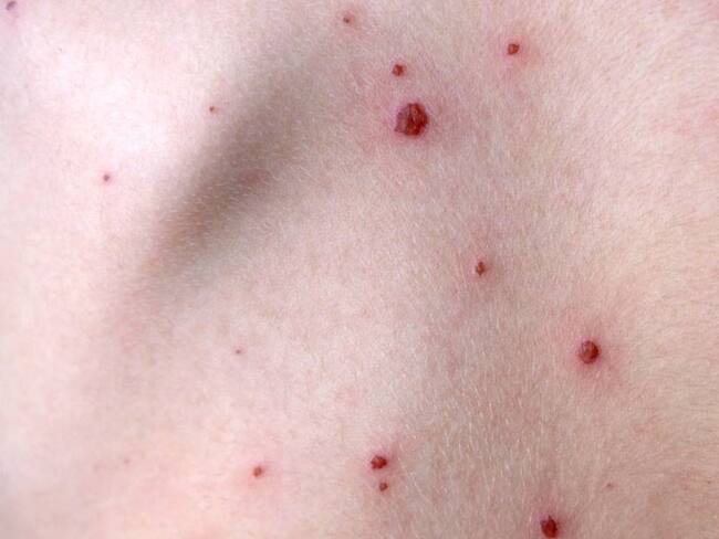 Colombia alcanzó los 289 casos de viruela. Foto: Getty Images.