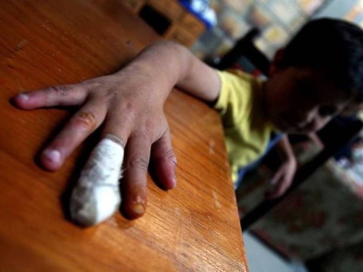 Se registra primera víctima por pólvora