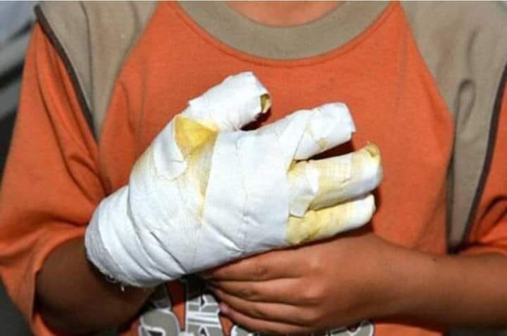 Quemados con pólvora. / Imagen de referencia.